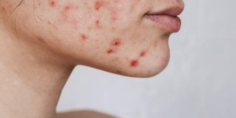 Skin Purging Isn’t What You Think It Is (And Your Skin Might Be Telling You Something Else)